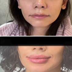 نمونه فیلر لب دکتر مهرناز توکلی