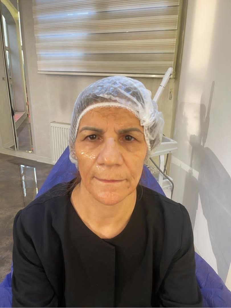 جوانسازی و تزریق