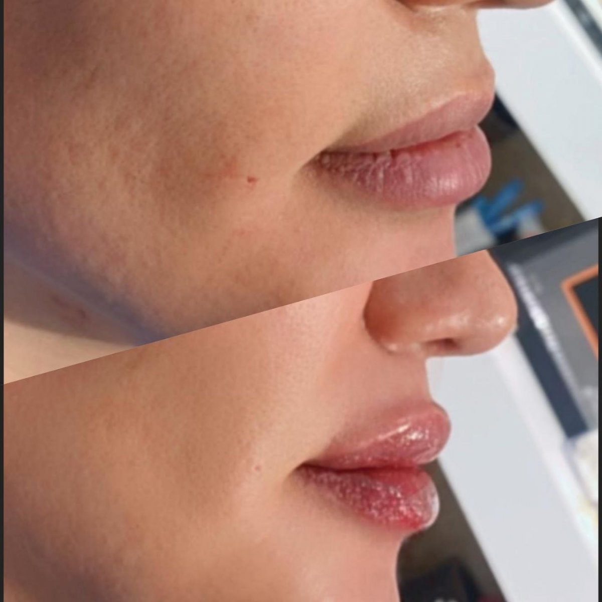 نمونه نزریق