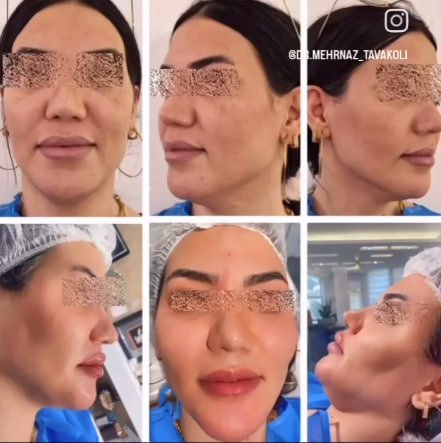 نمونه تزریق دکتر مهرناز توکلی